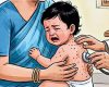২৪ ঘণ্টায় হাম ও উপসর্গে ১৭ মৃত্যু, বাড়ছে আক্রান্তের সংখ্যা